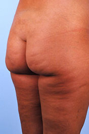 Before Brazilian Butt Lift
