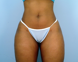 After Liposuction Virginia Beach