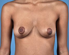 Breast Lift Virginia Beach