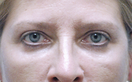 After Chesapeake Blepharoplasty