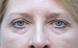 Before Blepharoplasty