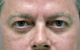 After Virginia Beach Blepharoplasty