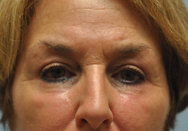 After Virginia Beach Eyelid Surgery