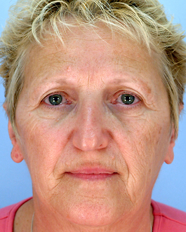 Facelift Virginia Beach