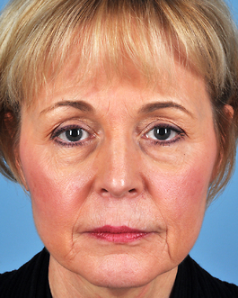 Facelift Before