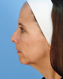 Facial Implants in Virginia Beach