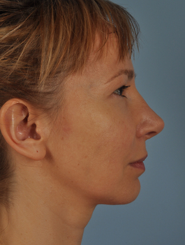 Facial Implants in Virginia Beach