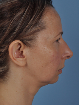 Facial Implants in Virginia Beach