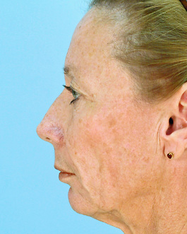 Facial Implants in Virginia Beach