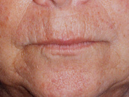 Laser Skin Resurfacing Virginia Beach