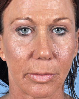 Laser Skin Resurfacing Virginia Beach