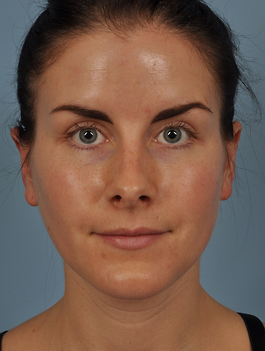 Otoplasty Virginia Beach