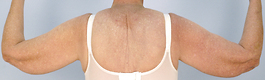 Arm Lift Before and After | Dr. Thomas Hubbard