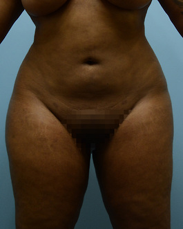 Brazilian Butt Lift Before and After | Dr. Thomas Hubbard
