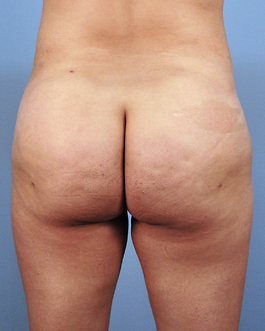 Brazilian Butt Lift Before and After | Dr. Thomas Hubbard