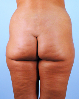 Brazilian Butt Lift Before and After | Dr. Thomas Hubbard