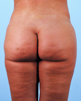 Brazilian Butt Lift Before and After | Dr. Thomas Hubbard