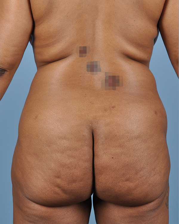 Brazilian Butt Lift Before and After | Dr. Thomas Hubbard