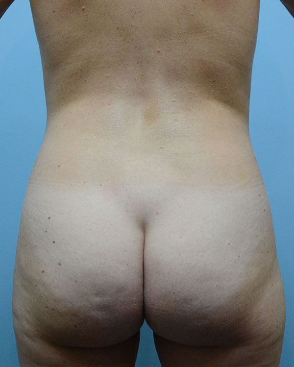 Brazilian Butt Lift Before and After | Dr. Thomas Hubbard