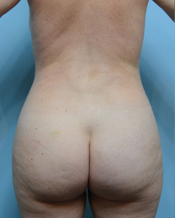 Brazilian Butt Lift Before and After | Dr. Thomas Hubbard