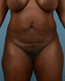 Brazilian Butt Lift Before and After | Dr. Thomas Hubbard