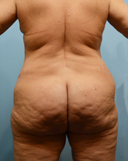 Brazilian Butt Lift Before and After | Dr. Thomas Hubbard