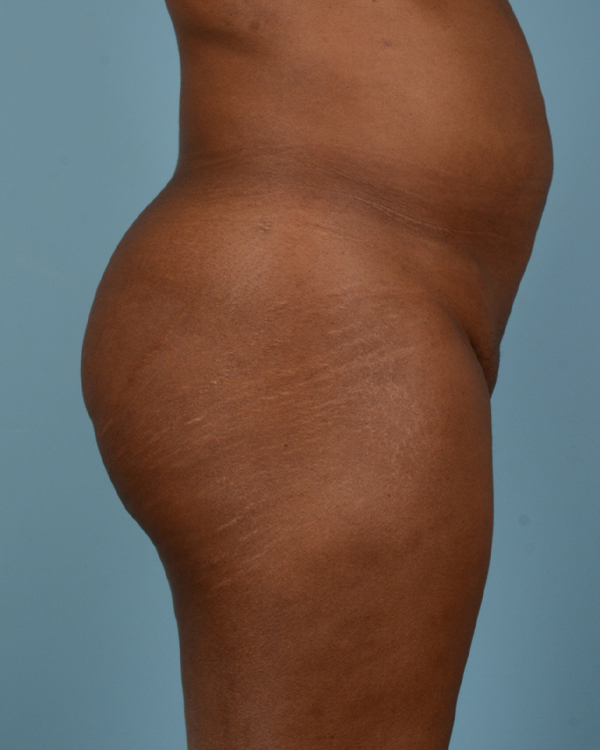 Brazilian Butt Lift Before and After | Dr. Thomas Hubbard