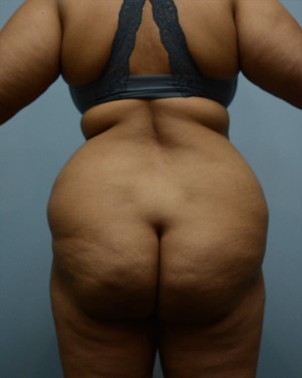 Brazilian Butt Lift Before and After | Dr. Thomas Hubbard