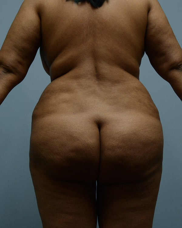 Brazilian Butt Lift Before and After | Dr. Thomas Hubbard