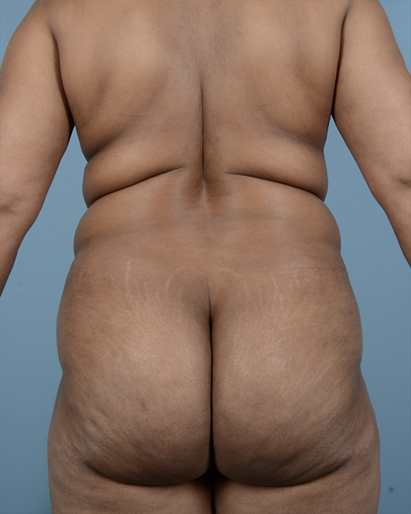 Brazilian Butt Lift Before and After | Dr. Thomas Hubbard