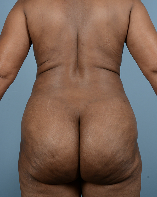 Brazilian Butt Lift Before and After | Dr. Thomas Hubbard