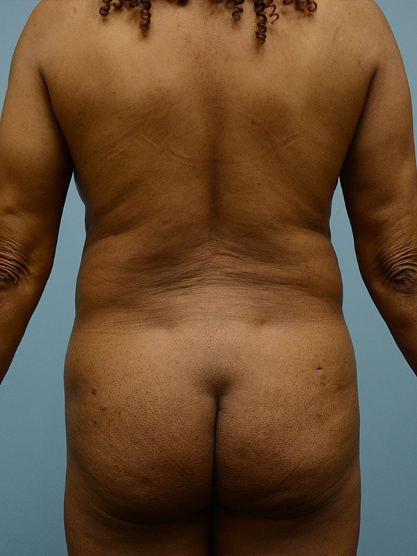 Brazilian Butt Lift Before and After | Dr. Thomas Hubbard