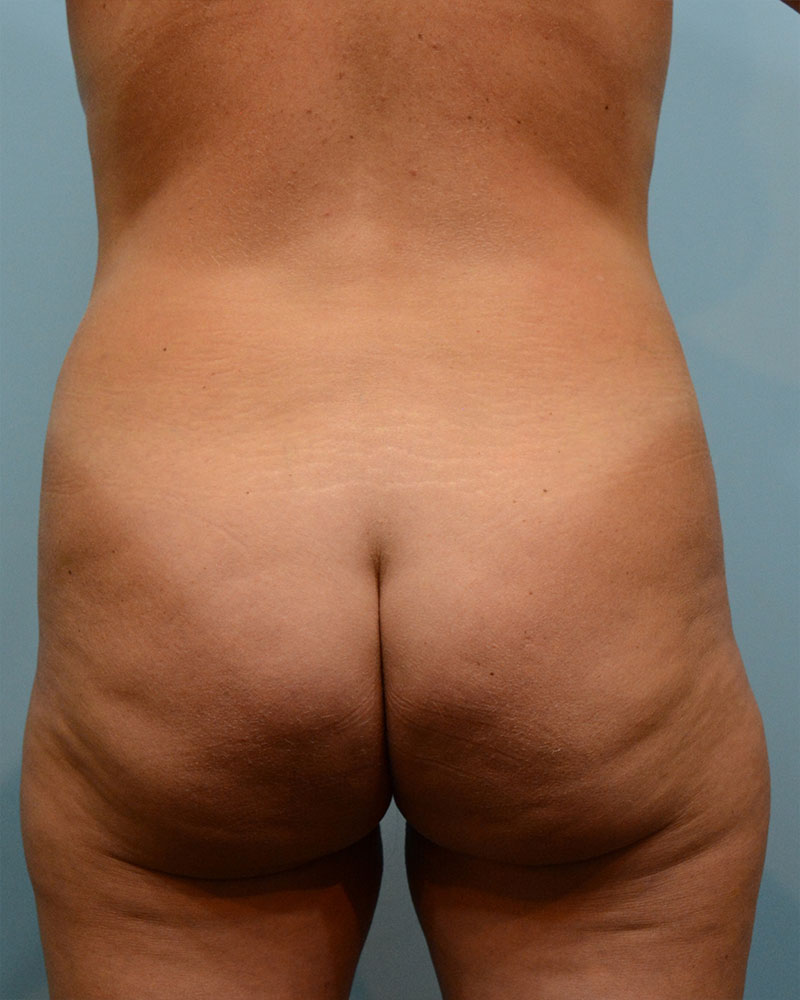 Brazilian Butt Lift Before and After | Dr. Thomas Hubbard