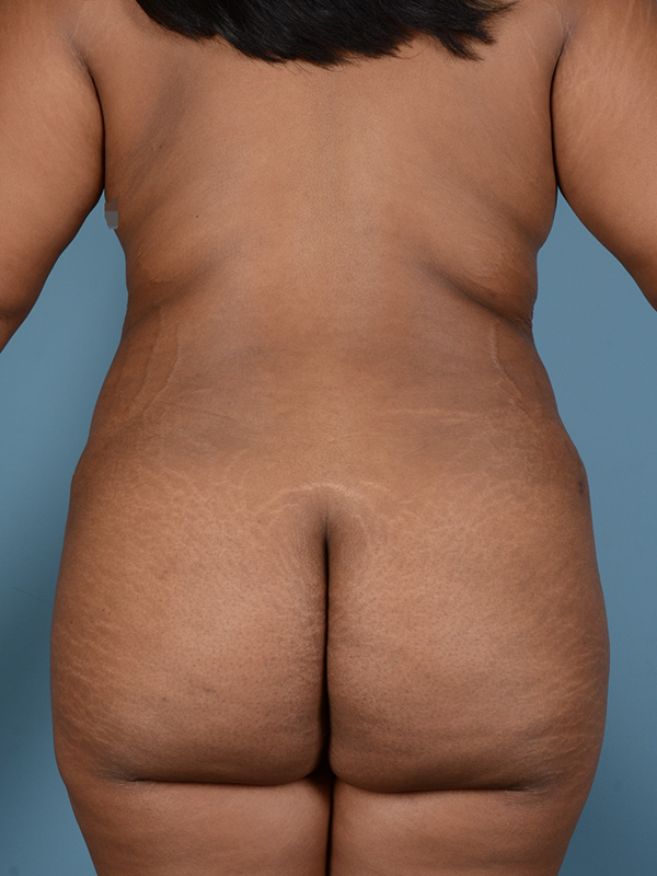 Brazilian Butt Lift Before and After | Dr. Thomas Hubbard