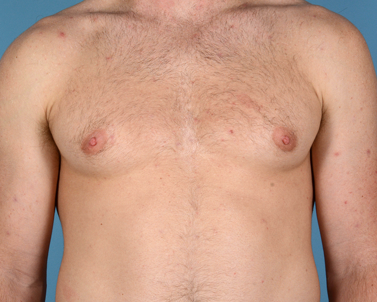 Gynecomastia Before and After | Dr. Thomas Hubbard