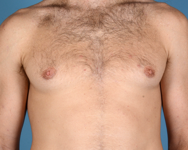 Gynecomastia Before and After | Dr. Thomas Hubbard