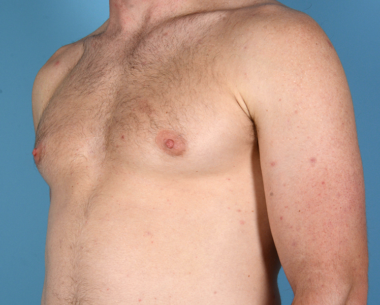 Gynecomastia Before and After | Dr. Thomas Hubbard