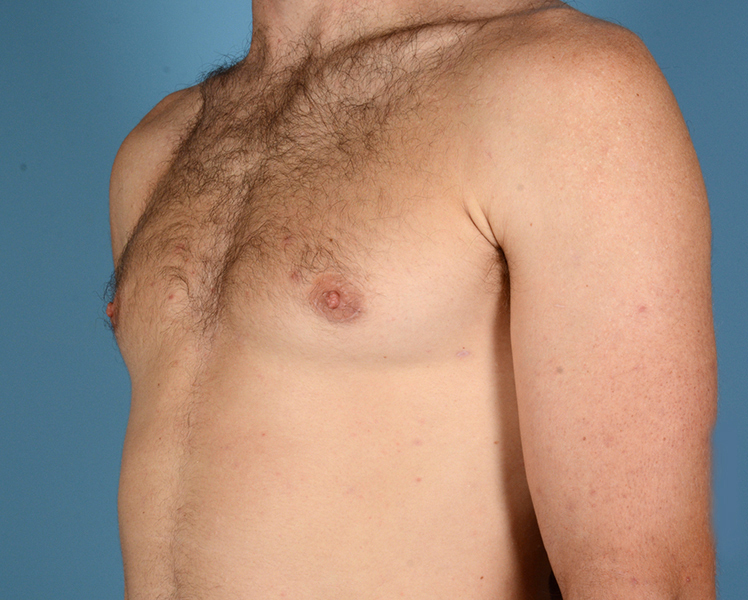 Gynecomastia Before and After | Dr. Thomas Hubbard