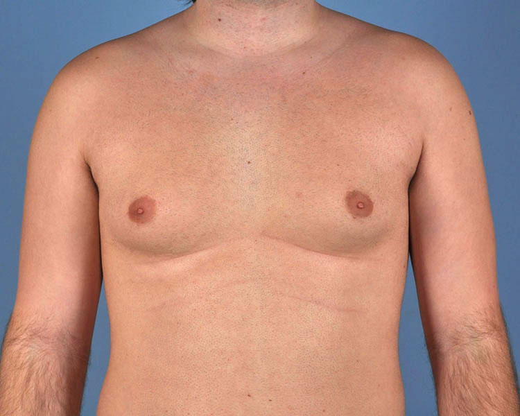 Gynecomastia Before and After | Dr. Thomas Hubbard