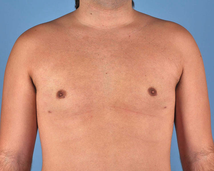 Gynecomastia Before and After | Dr. Thomas Hubbard