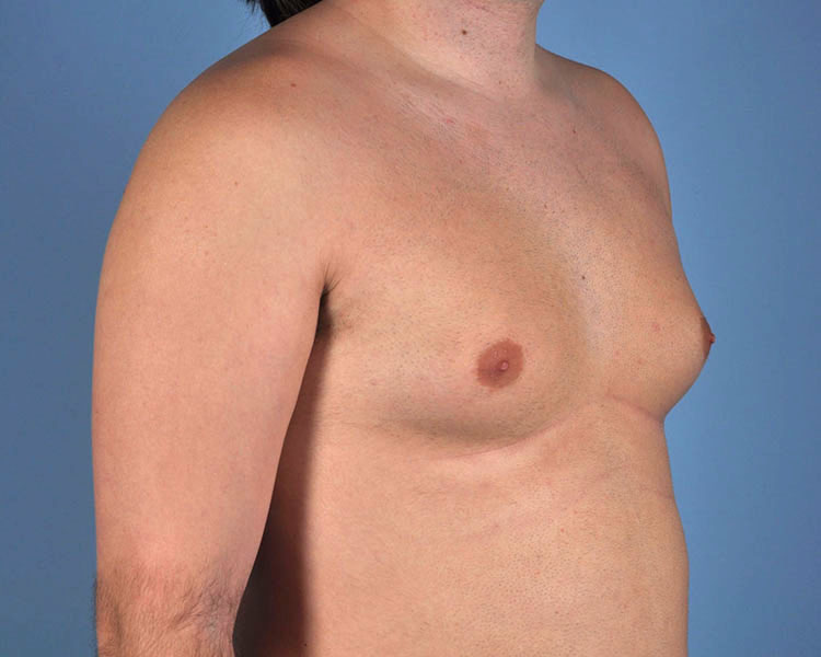 Gynecomastia Before and After | Dr. Thomas Hubbard