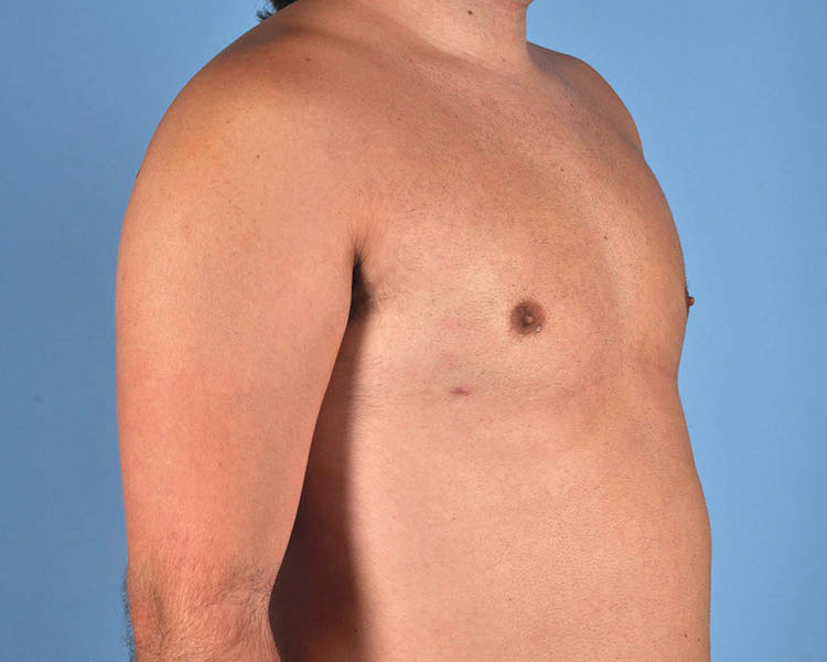 Gynecomastia Before and After | Dr. Thomas Hubbard