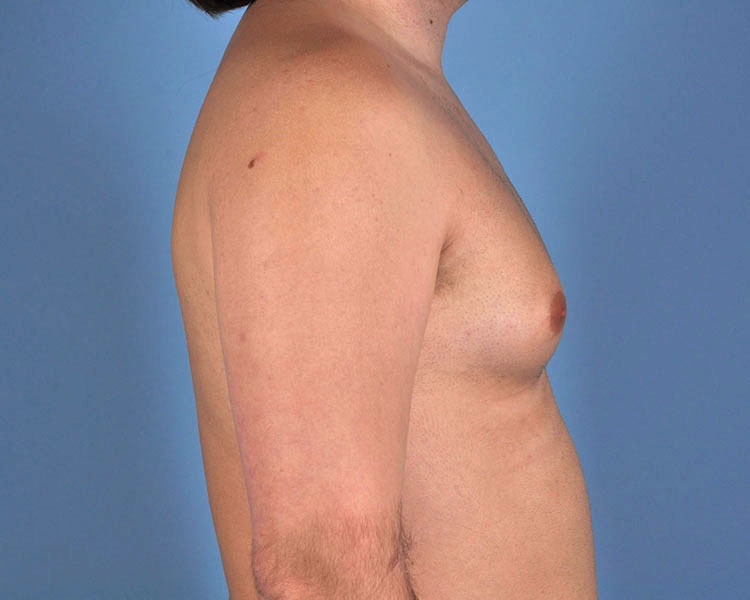 Gynecomastia Before and After | Dr. Thomas Hubbard