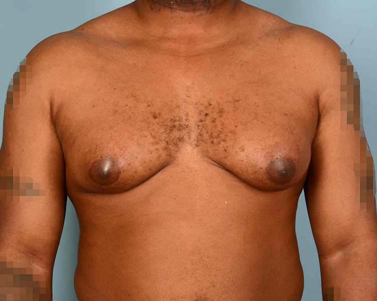 Gynecomastia Before and After | Dr. Thomas Hubbard