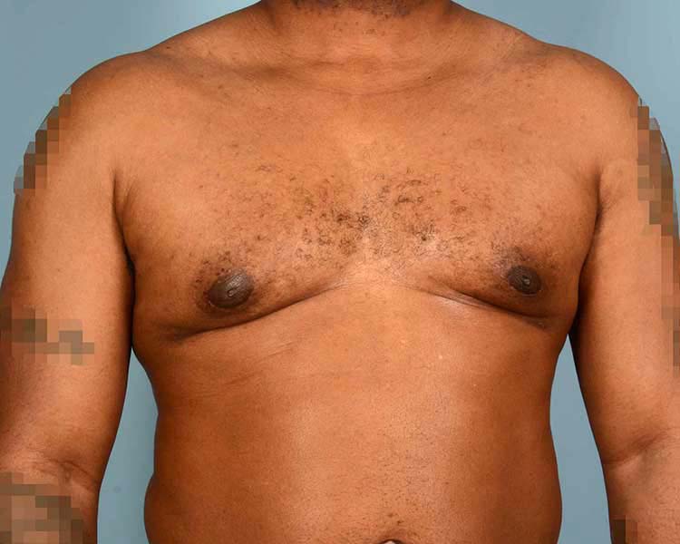 Gynecomastia Before and After | Dr. Thomas Hubbard