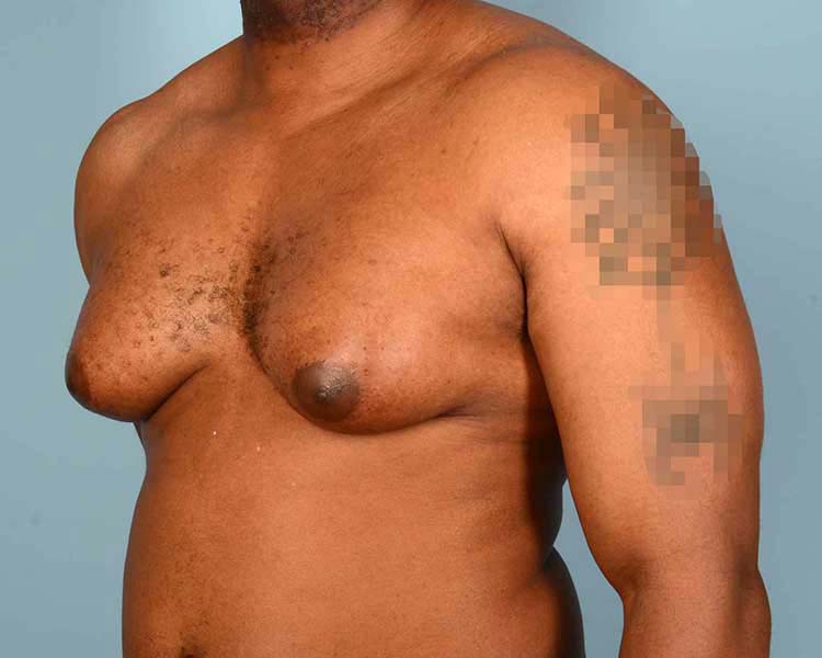 Gynecomastia Before and After | Dr. Thomas Hubbard