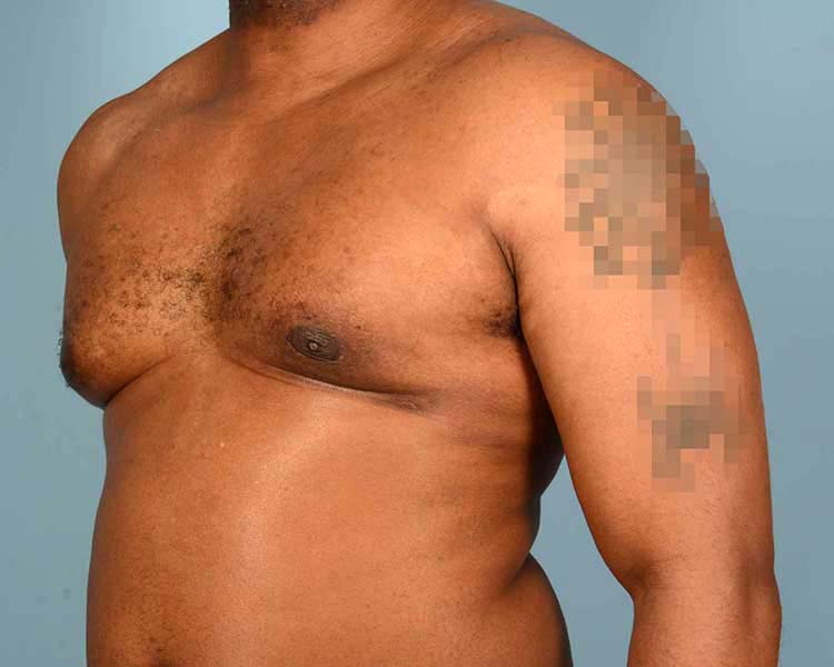 Gynecomastia Before and After | Dr. Thomas Hubbard