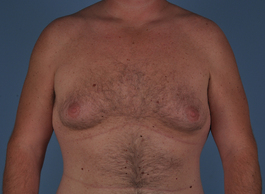 Gynecomastia Before and After | Dr. Thomas Hubbard