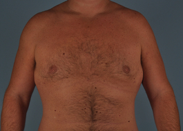 Gynecomastia Before and After | Dr. Thomas Hubbard