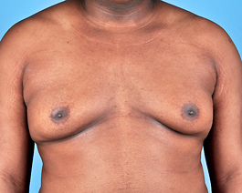 Gynecomastia Before and After | Dr. Thomas Hubbard